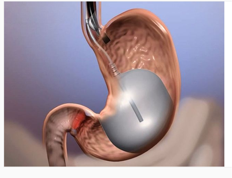 Endoscopia Bariátrica | Centro Médico Teknon